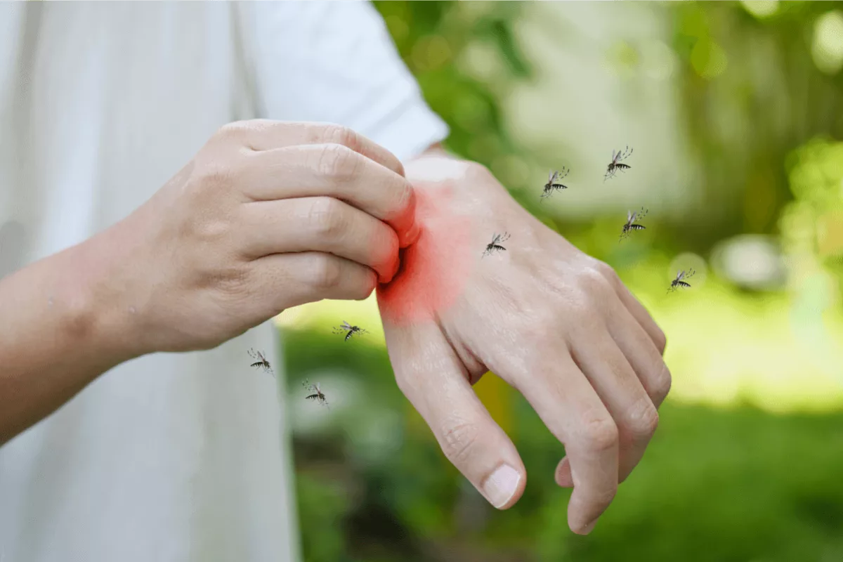 Man itching scratching hand from allergy skin rash caused by mosquitoes bite